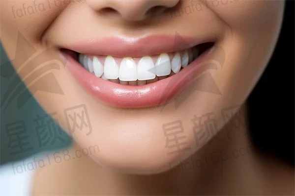 涟源牙牙口腔医院牙齿美白全程体验：咨询到结果，重拾自信微笑，感受焕然一新的魅力与自信。