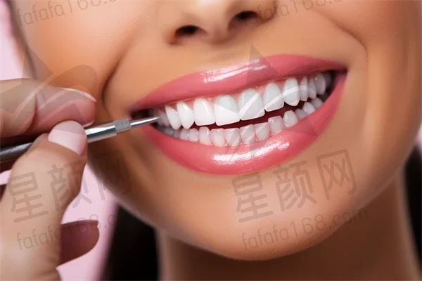 吉安牙齿美白费用是多少？2025年牙齿美白价格齐全解析，附带牙贴面价格信息。