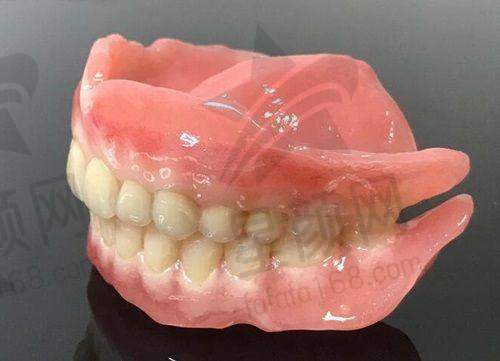 种植牙项目优势