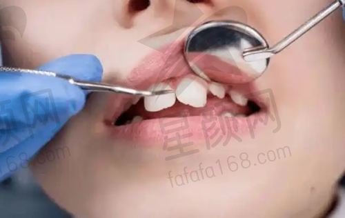 廊坊圣洁口腔连锁种植一颗大牙价格
