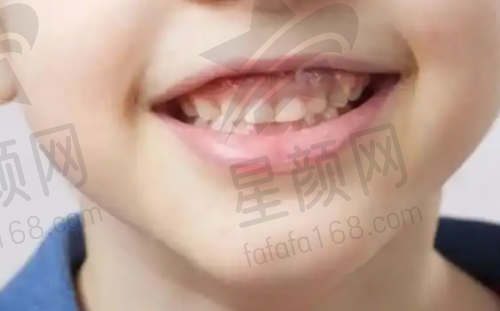 牙冠项目