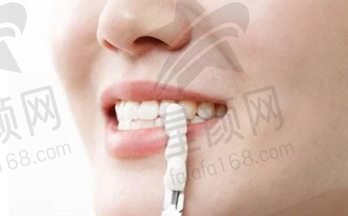 正畸皮筋挂法步骤