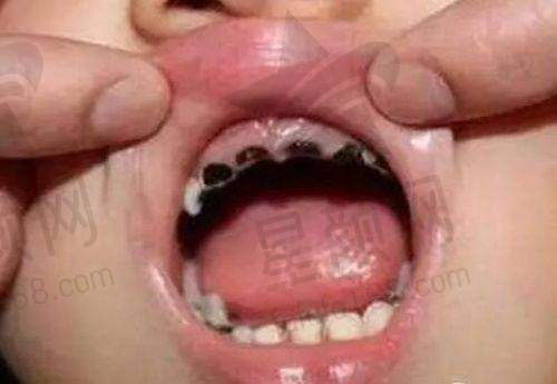种植牙