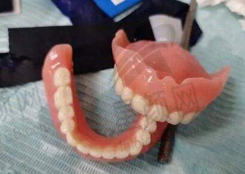 正畸实例分享