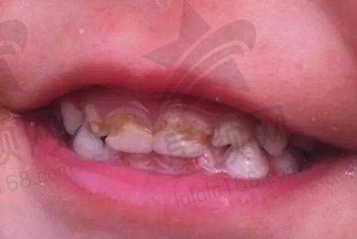 洗牙补牙体验